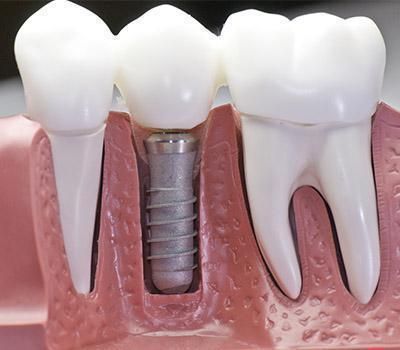 Implant Dentures in Redwood City & Pleasanton CA Implant Dentures in Redwood City & Pleasanton CA